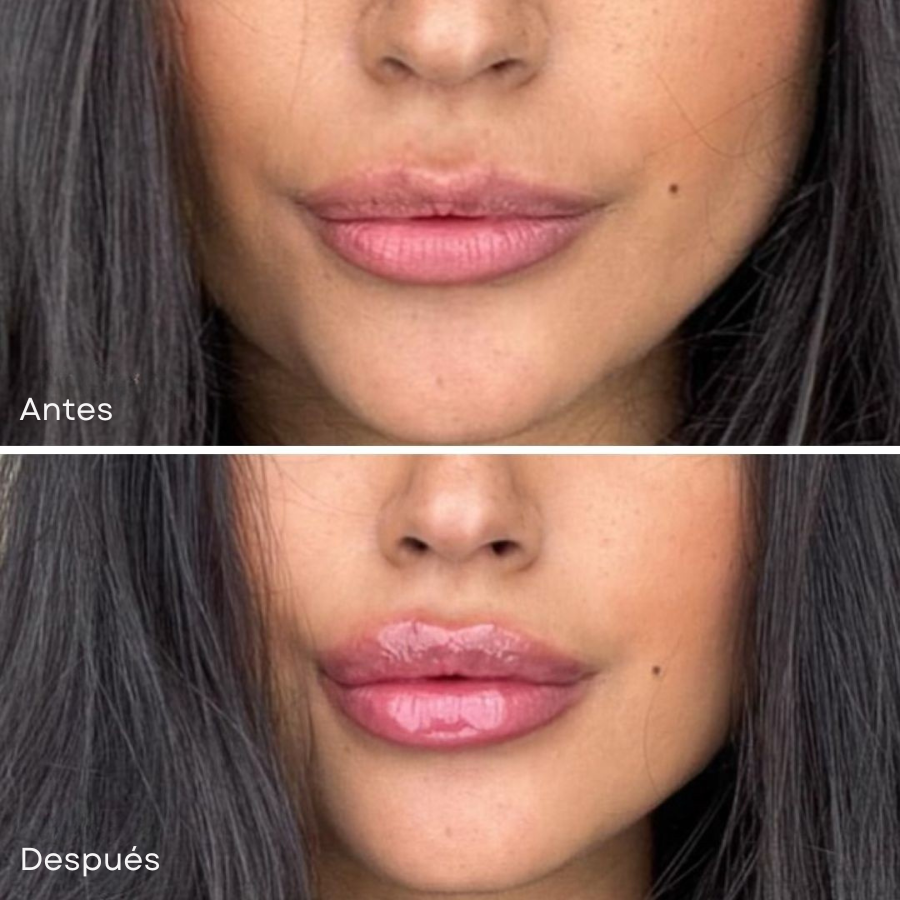 Voluminizador de labios